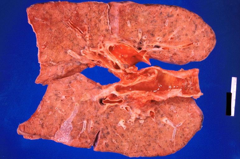 Lung: Pulmonary fibrosis and atherosclerosis of pulmonary artery