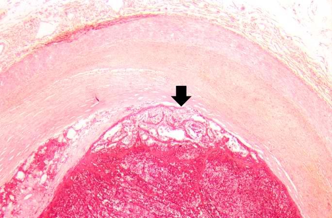 This is a high-power photomicrograph of thrombus attached to the wall of the vessel. There is early organization of the thrombus (arrow).