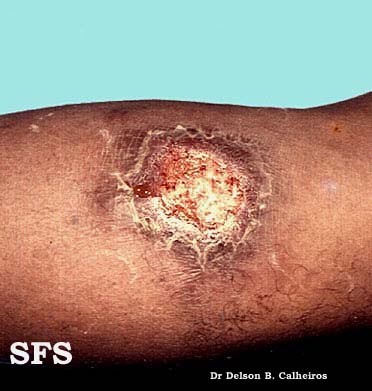 Cutaneous leishmaniasis. Adapted from Dermatology Atlas.[1]