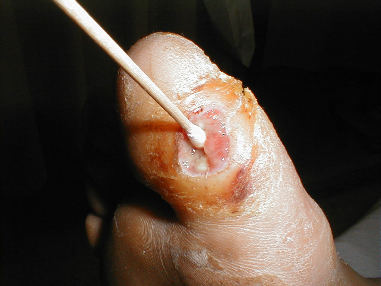 Diabetes induced neuropathy led to development of the ulcer shown above. The Q-tip easily passes to the level of the underlying bone, clinical evidence of osteomyelitis. Incidentally, this is not painful to the patient as he is insensate.