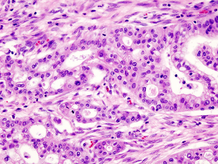 File:Pancreas adenocarcinoma - 4.jpg