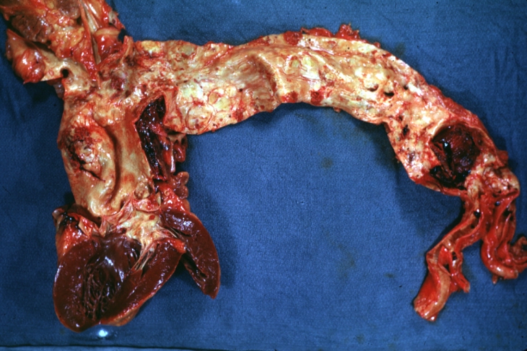 Dissecting Aneurysm: Gross shows dilated aorta with extensive atherosclerosis dissection is seen, a small abdominal aorta atherosclerotic aneurysm is present good for association of dilation with dissection