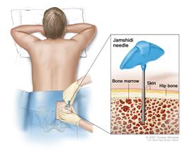 Bone marrow aspiration and biopsy. After a small area of skin is numbed, a Jamshidi needle (a long, hollow needle) is inserted into the patient’s hip bone. Samples of blood, bone, and bone marrow are removed for examination under a microscope.[34]