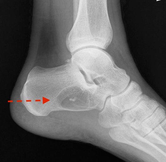 Cockade sign: Classic appearance of an intraosseous lipoma of the calcaneus which presents as a well-defined lytic lesion with a central calcification resembling a cockade Adapted from Radiopedia