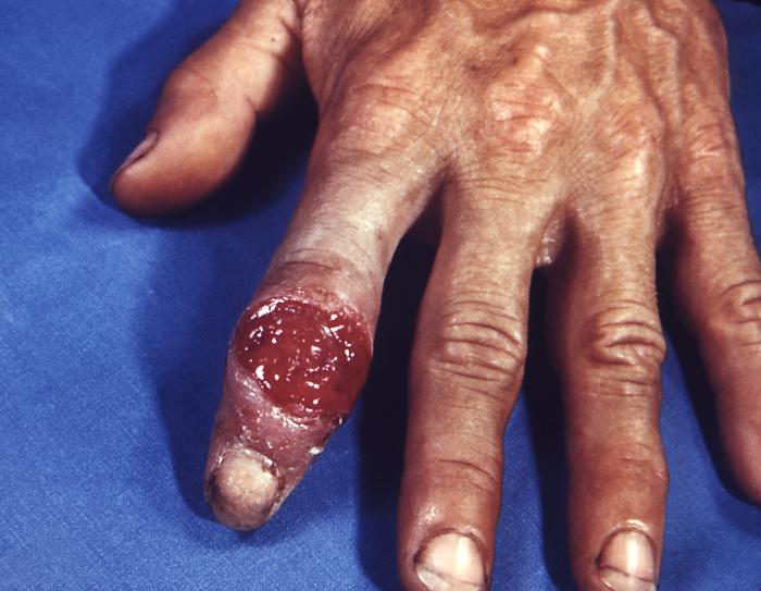 Primary chancre of syphilis at the site of infection on the hand