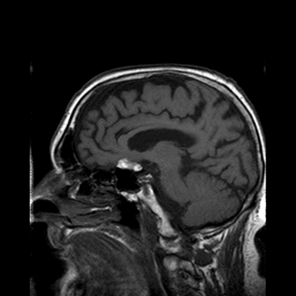 Intracranial dermoid cyst:A hyperintense well-delineated mass is seen in the right frontal lob with it's base on the roof of the sphenoid sinus.[2]