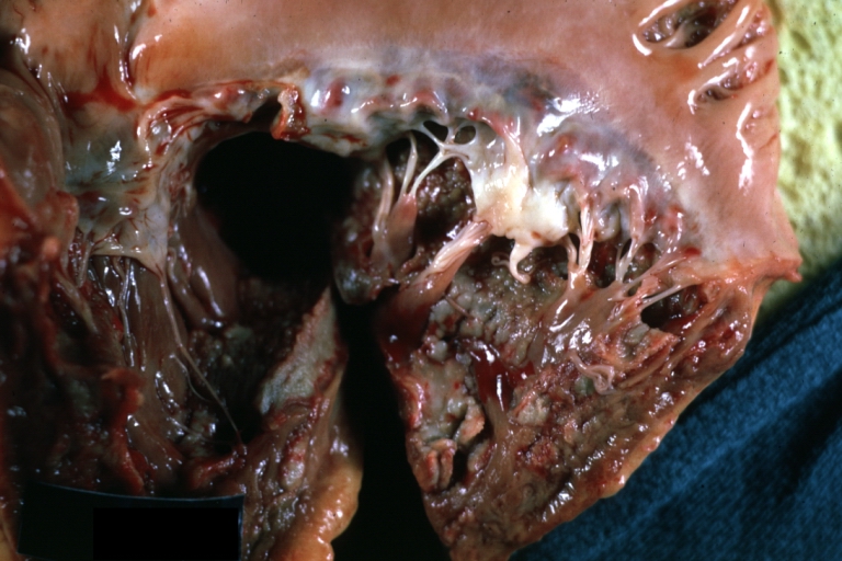HEART: Eosinophilic Endomyocarditis: Gross natural color extensive thrombi in patient with eosinophilic leukemia