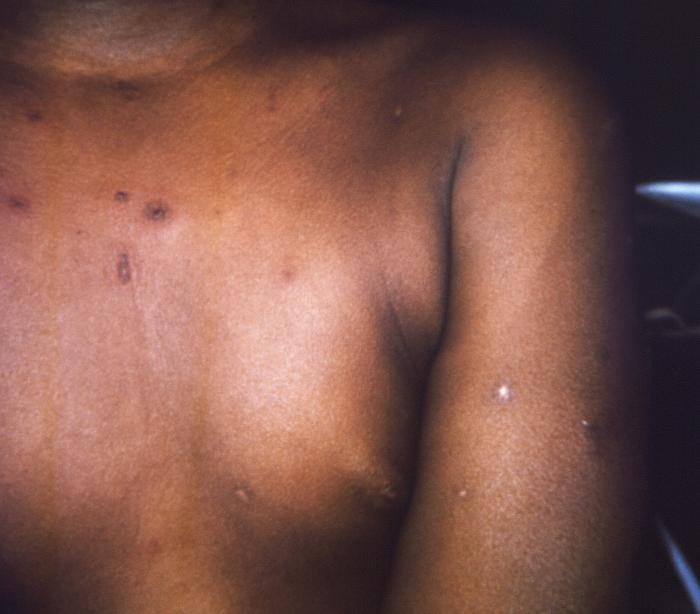 Chest surface of a 2 year-old female patient who after receiving a smallpox vaccination in her left shoulder region, developed an erythema multiforme reaction. Note the maculopapular rash, which had spread to her chest and left upper arm.Adapted from Public Health Image Library (PHIL), Centers for Disease Control and Prevention.[3]