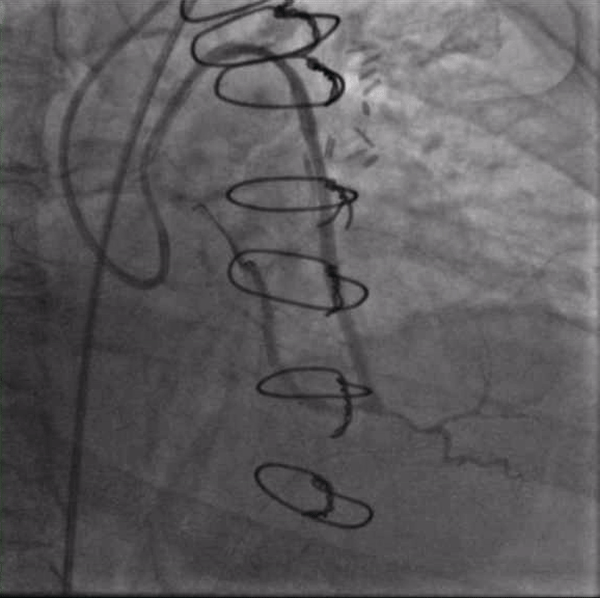 Video 2. A wire in the ostial circumflex supported by an OTW balloon and a guide extension catheter. Note the kink just proximal to the anatamosis of the SVG to the OM and poor flow in the distal LAD.