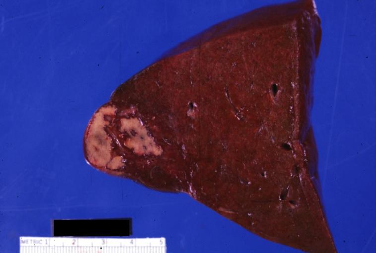 Ischemia: Gross natural color close-up of liver with shock necrosis and a large area of necrosis beneath capsule quite good burn sepsis DIC