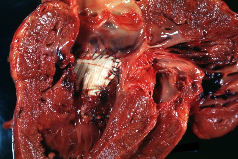 Interventricular Septal Defect (Perimembranous) with Patch Repair: Gross, natural color, view from left ventricular outflow tract