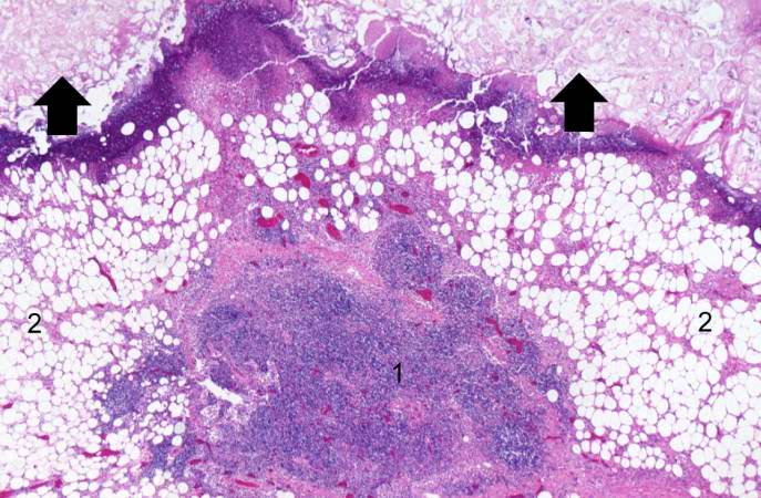 This high-power photomicrograph shows areas of inflammation (1) and fat necrosis (arrows) in the peripancreatic fat tissue (2) of the pancreas from this case.
