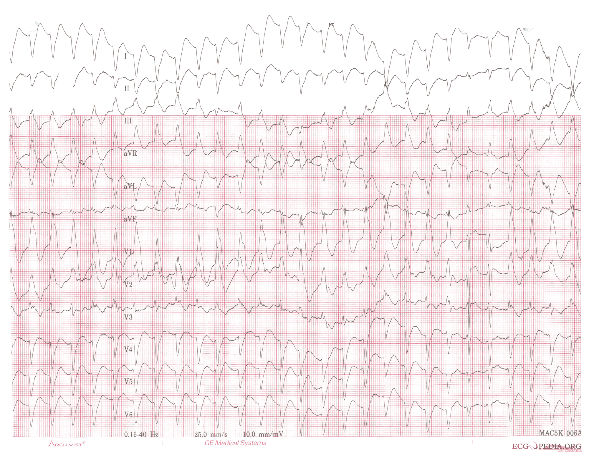 Ventricular tachycardia of 150 bpm with a right bundle branch block pattern and right heart axis. Note the 5th and 6th complex from the right side. These are fusion complexes.
