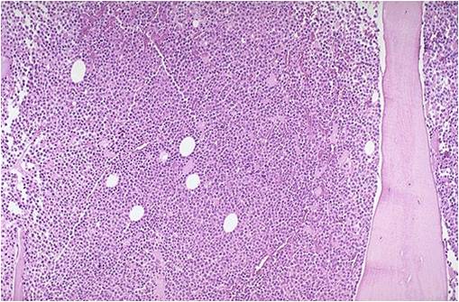 Bone marrow biopsy in multiple myeloma. (Image courtesy of Melih Aktan M.D.)