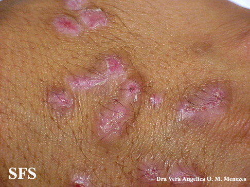Epidermolysis bullosa pruriginosa. Adapted from Dermatology Atlas.[1]