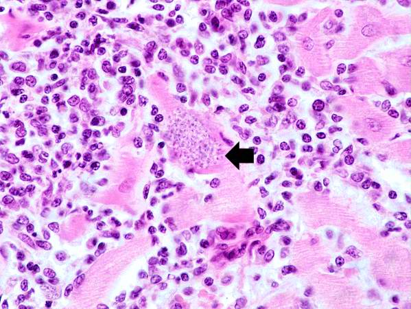 This is a higher-power photomicrograph of an H & E stained heart biopsy from this patient. Again, note the organisms within a myocyte (arrow) and the inflammatory response.