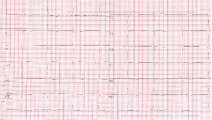 A 12 lead ECG of a patient with a body temperature of 32 degrees Celsius. Note the sinus bradycardia, the prolonged QT interval (QTc is not prolonged) and the Osborn J wave, most prominently in leads V2-V5