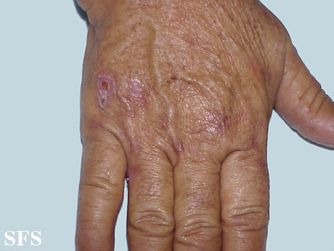 Porphyria cutanea tarda. Adapted from Dermatology Atlas.[2]