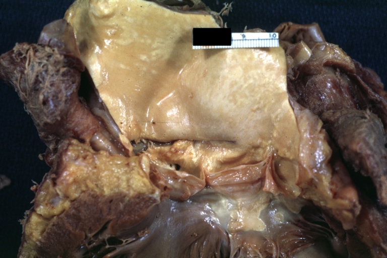 Dissecting Aneurysm: Gross, a very good example of dissection beginning just above aortic ring
