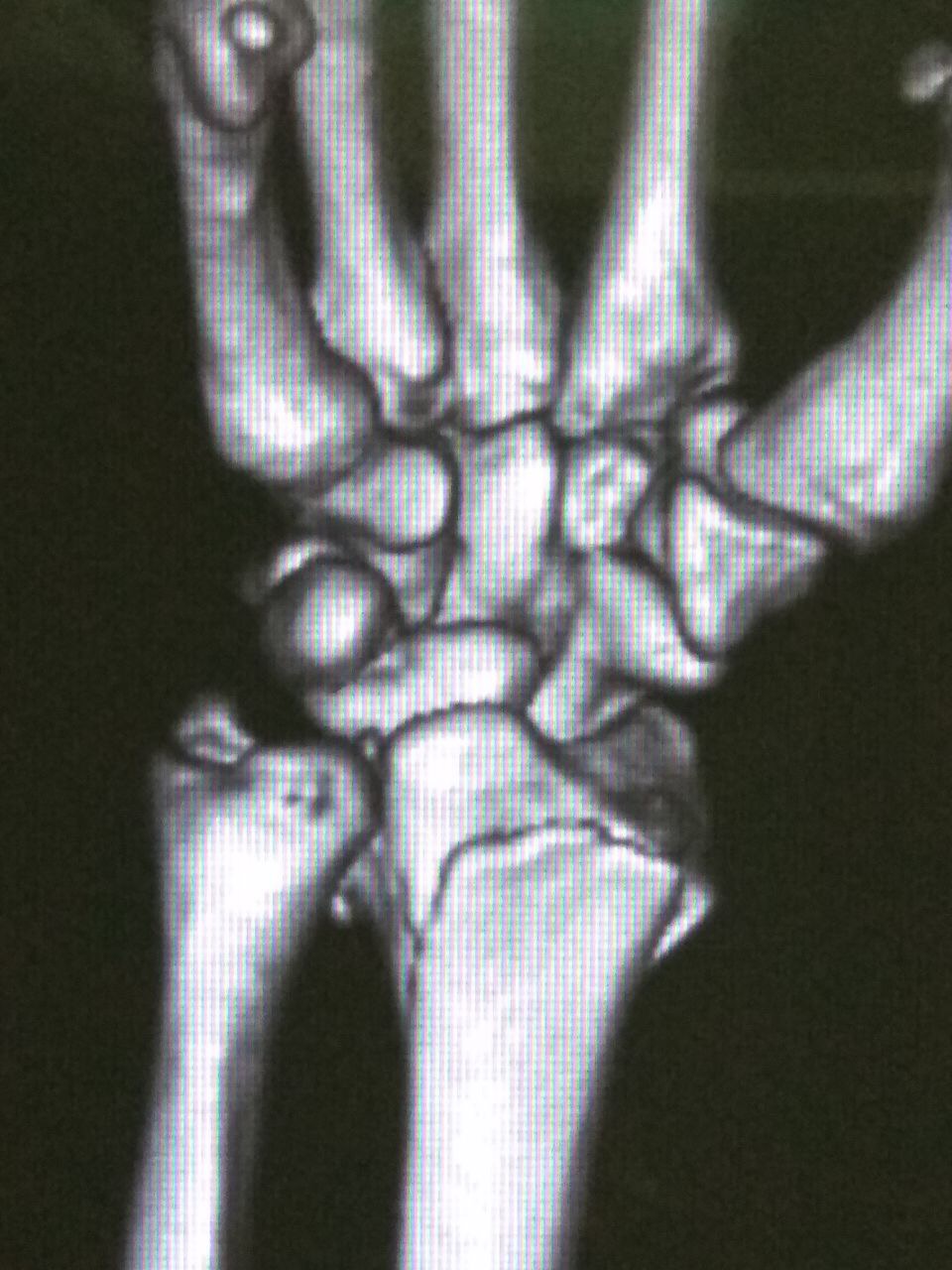File:CT scan wrist ventral view.JPG