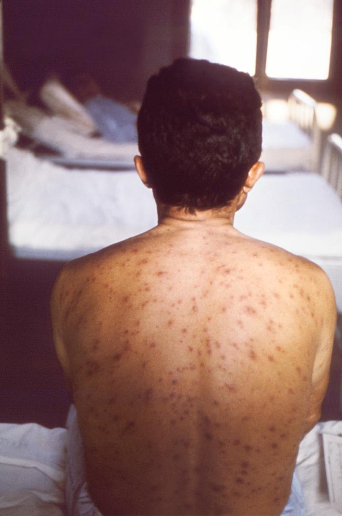 Posterior view of a hospitalized man's neck, back and shoulders, who’d been assigned a bed in a smallpox ward, due to an initially misdiagnosed illness, which turned out to be chickenpox. From Public Health Image Library (PHIL). [24]