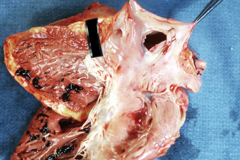 Atrial Septal Defect: Gross, (an excellent example) foramen ovale defect with right ventricular hypertrophy and fatty infiltration of the right ventricular wall, enlarged right atrium
