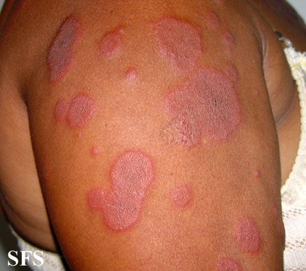 Erythema multiforme Adapted from Dermatology Atlas.