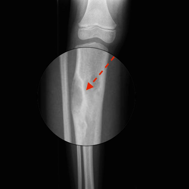Rind sign: a lesion surrounded by a layer of thick, sclerotic reactive bone (rind) and is suggestive of fibrous dysplasia Adapted from Radiopedia