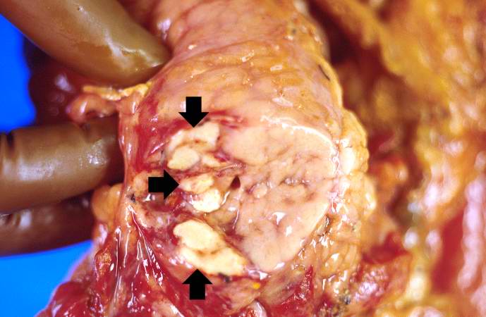 This gross photograph of the pancreas from this case shows white nodules (arrows) in the pancreas and the adjacent mesenteric fat tissue.