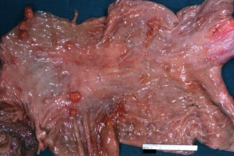 Stomach: Polyps: Gross, natural color, an excellent example of multiple gastric polyps