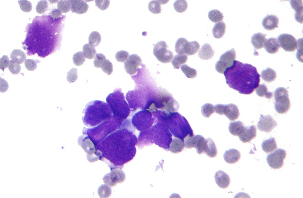 File:Lung small cell cancer 01.jpeg