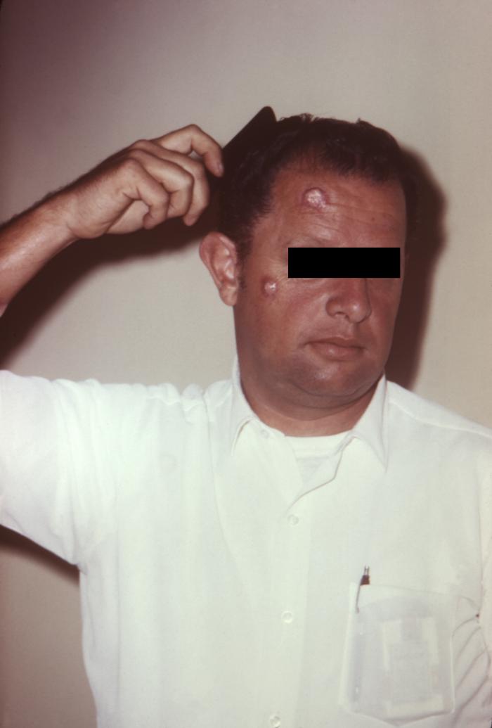 "Symptoms of cutaneous anthrax due to B. anthracis.”Adapted from Public Health Image Library (PHIL), Centers for Disease Control and Prevention.[21]