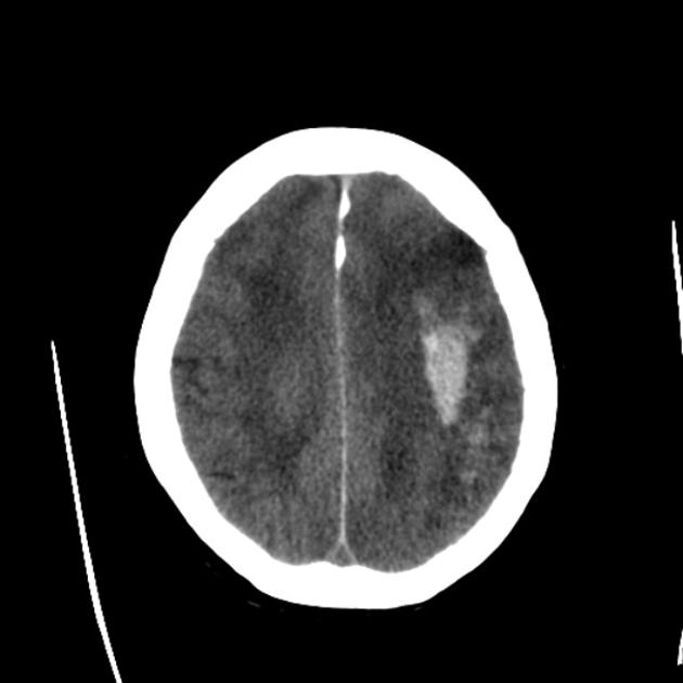 Large hemorrhagic focus in the left cerebral hemisphere that extends to the infratentorial region with a significant mass effect