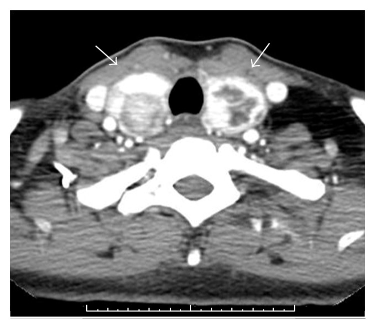 File:Thyroid gland in Cowden syndrome.gif