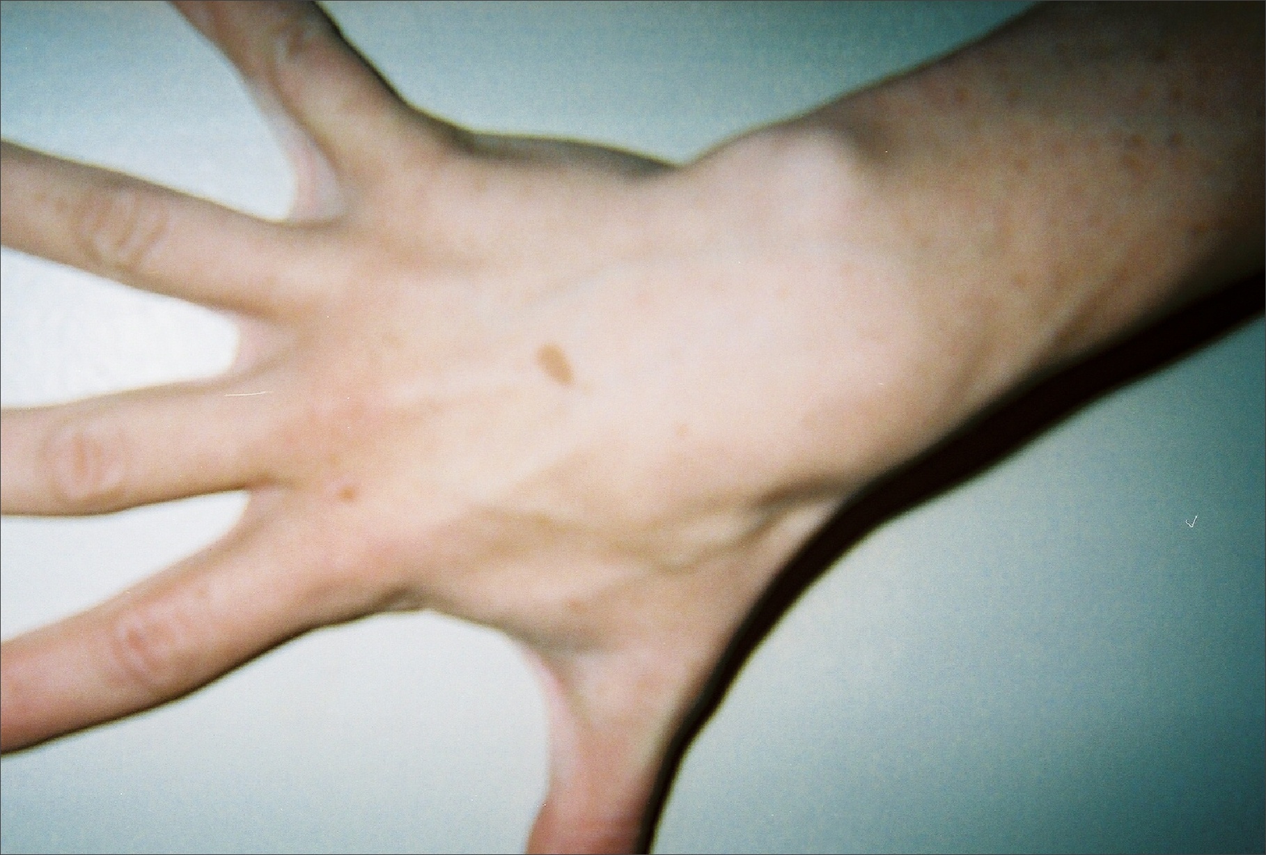 Hand of thirty seven year old patient showing interdigital webbing