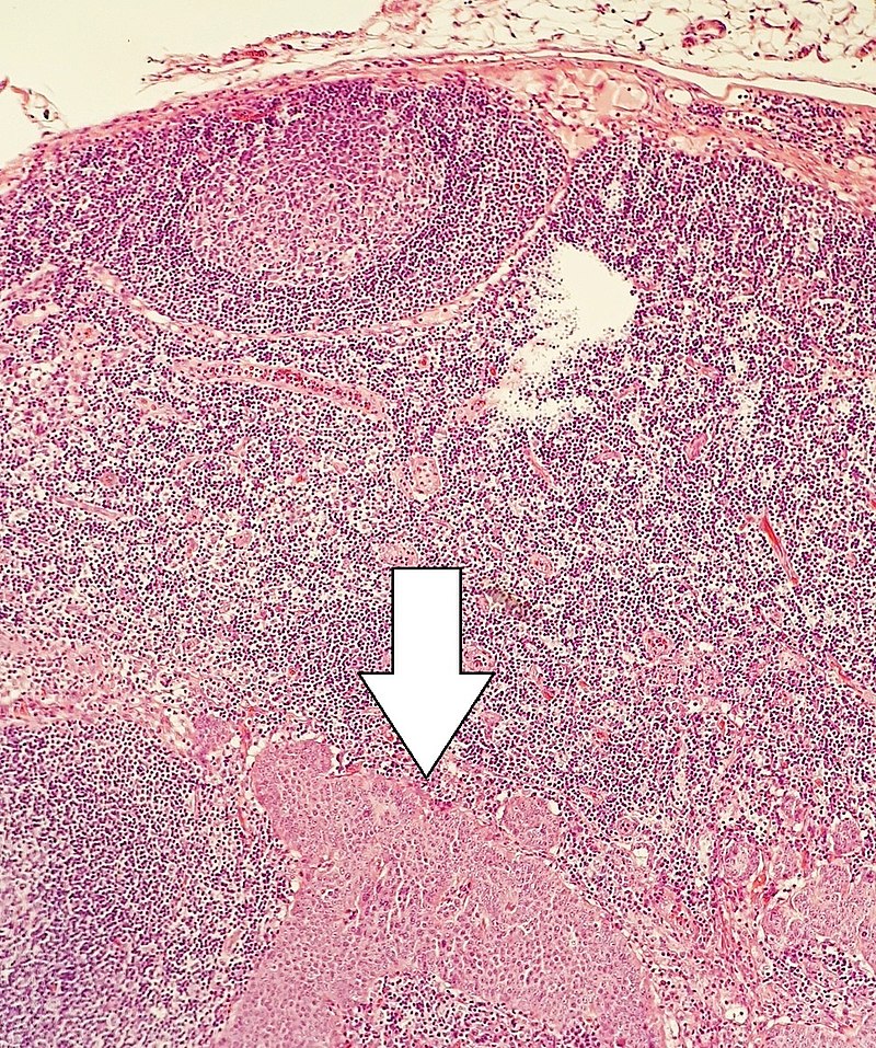 File:800px-Lymph node metastasis from neuroendocrine tumor.jpg
