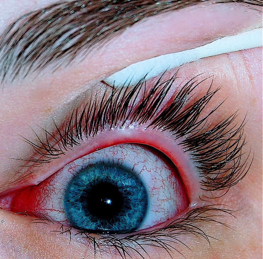 Viral conjunctivitis - By Joyhill09 - I took this photo with a Nikon D40 of my eye infected with conjunctivitis, CC BY-SA 3.0, https://commons.wikimedia.org/w/index.php?curid=18954730