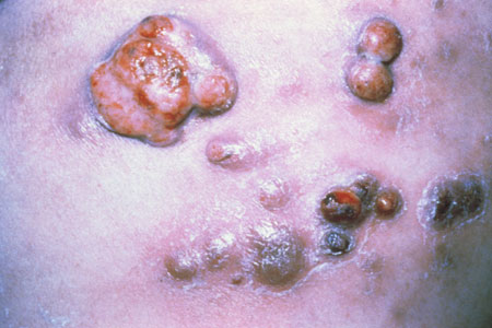 Bacillary Angiomatosis Image obtained from U.S. Department of Veterans Affairs - Image Library [17] (Paul A. Volberding, MD, University of California San Francisco)