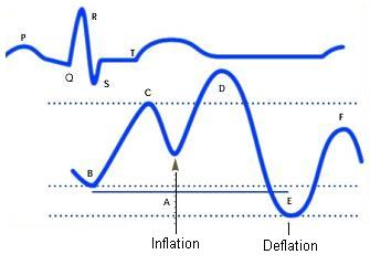 Diagram of correct intra aortic balloon timing; A= One complete cardiac cycle, B= Unassisted aortic end diastolic pressure, C= Unassisted systolic pressure, D= Diastolic augmentation, E= Reduced aortic end diastolic pressure, F= Reduced systolic pressure]]