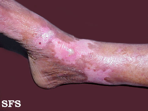 Epidermolysis bullosa dystrofic dominant. Adapted from Dermatology Atlas.[3]