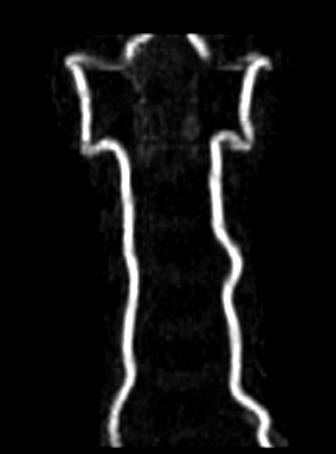 MRI: Normal neck