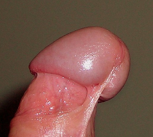 An uncircumcised glans penis