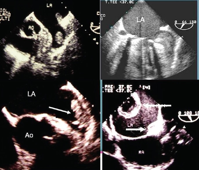 File:Transesophageal echocardiography.jpg