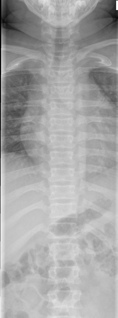 File:Achondroplasia (10).jpg