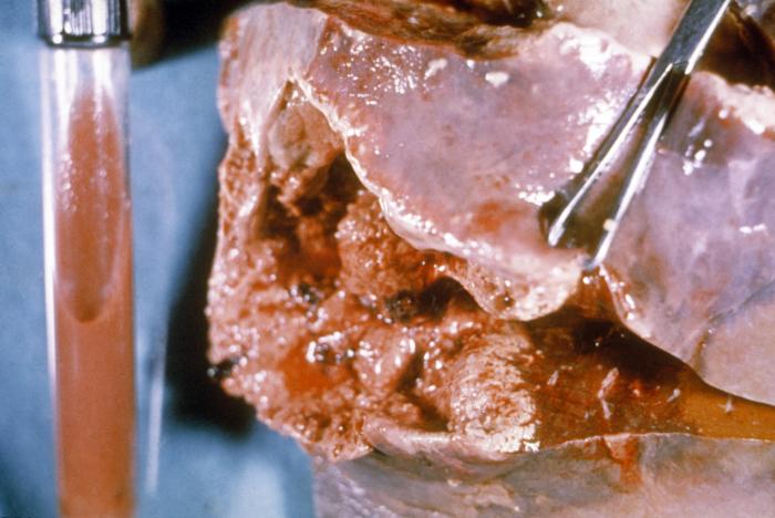 Amebic abscess of liver. Adapted from Public Health Image Library (PHIL). [1]