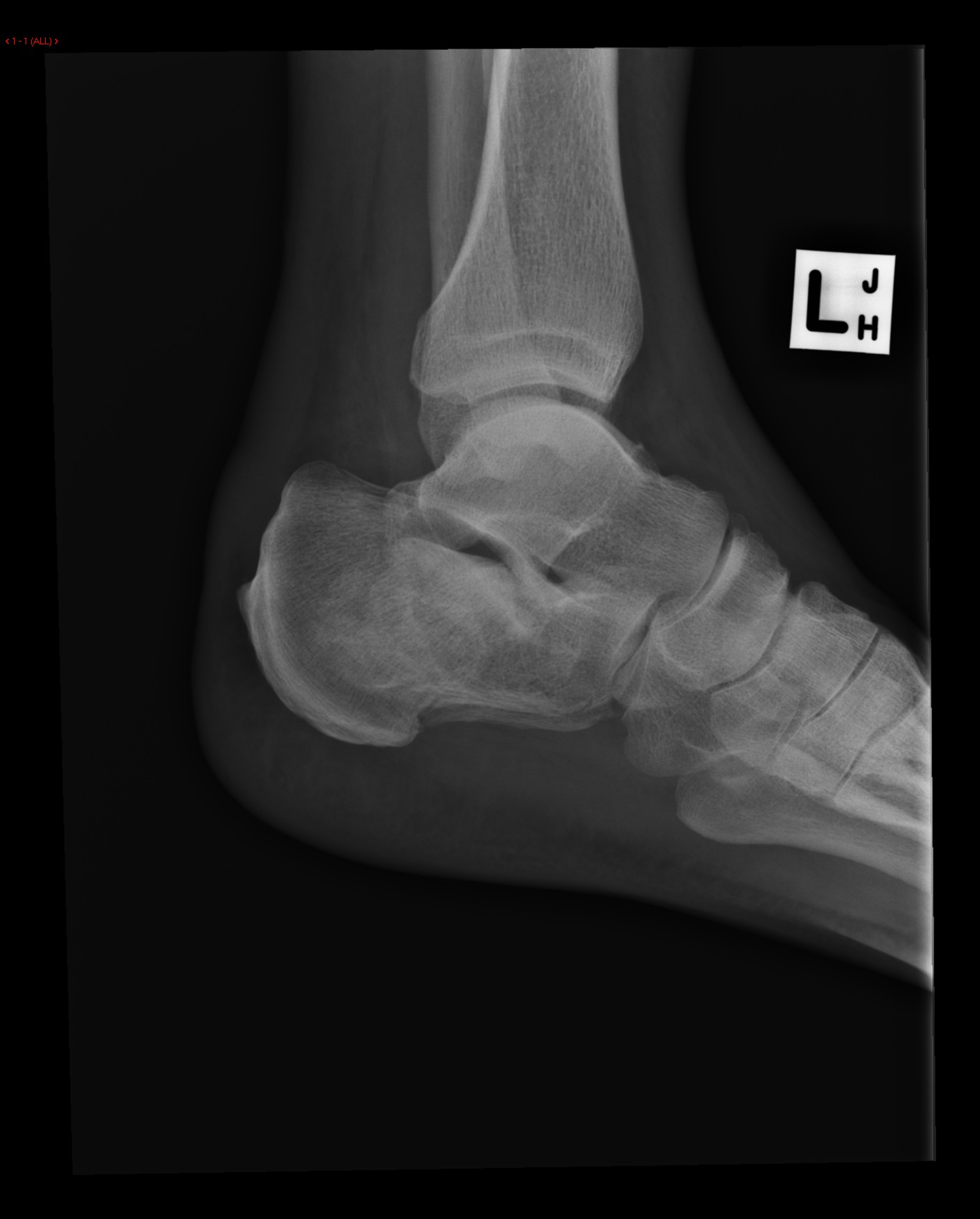 Lateral Plain films show a comminuted fracture of the left calcaneus with a flattening of Bohler's angle.