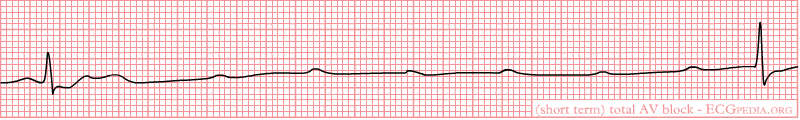 File:Complete heart block4.png