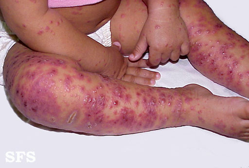 File:Eczema herpeticum07.jpg