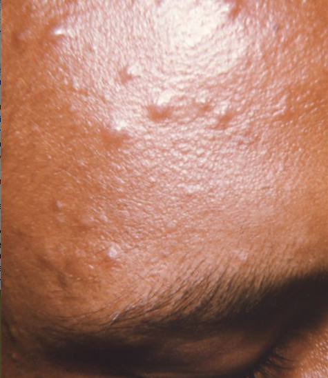 Skin surface displayed characteristic maculopapular vesicles of the milder form of smallpox, or the DNA virus, variola minor. From Public Health Image Library (PHIL). [5]