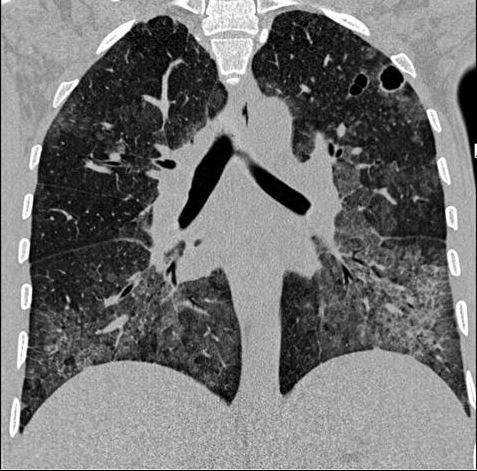 File:CT PCP (pneumocystis jirovecii) pneumonia.png